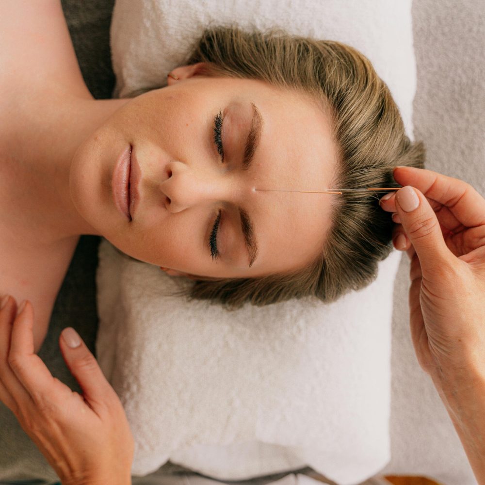 woman getting acupuncture